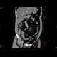 Inflammation of the cecum: CT - Computed tomography